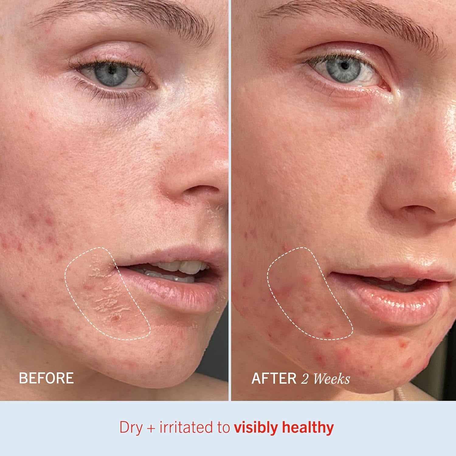 Ultra Repair Cream Intense Hydration Moisturiser for Face and Body – Rich Whipped Texture for Immediate Skin Hydration, 170.1G