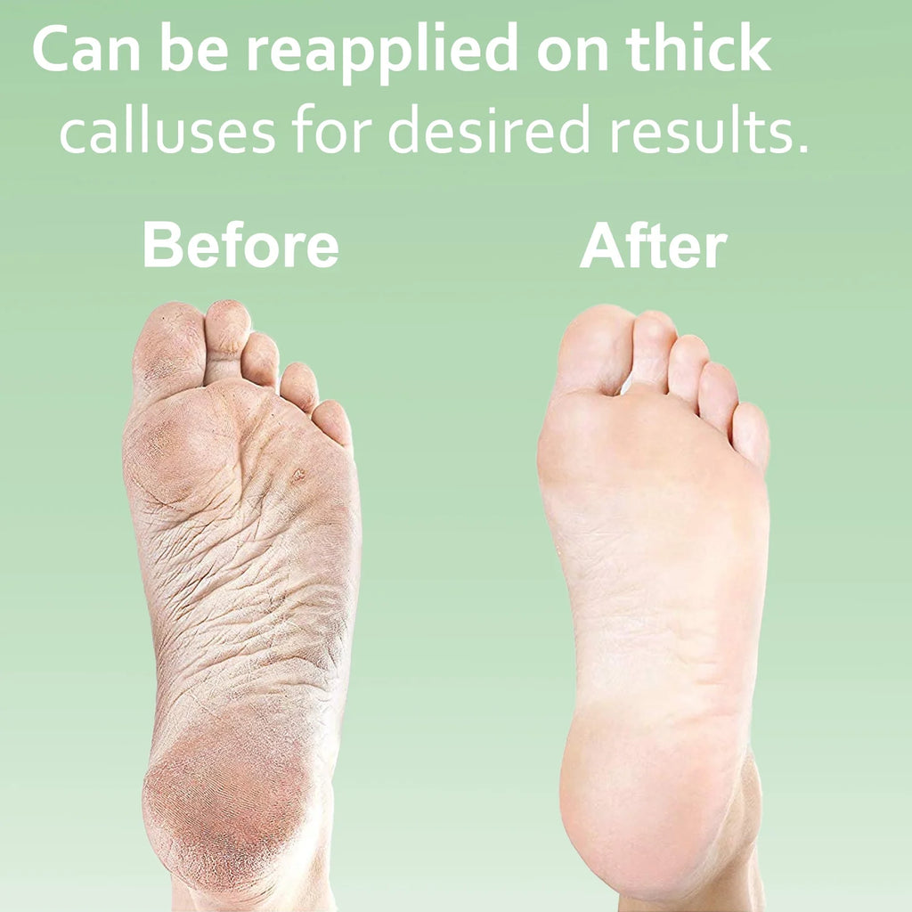 Dr. Entre's Callus Remover Gel – Foot Callus Remover Spa Kit with Pedicure Tools, Dead Skin Scrubber