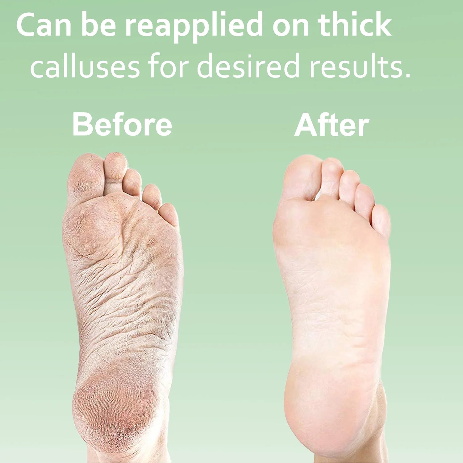 Dr. Entre's Callus Remover Gel – Foot Callus Remover Spa Kit with Pedicure Tools, Dead Skin Scrubber