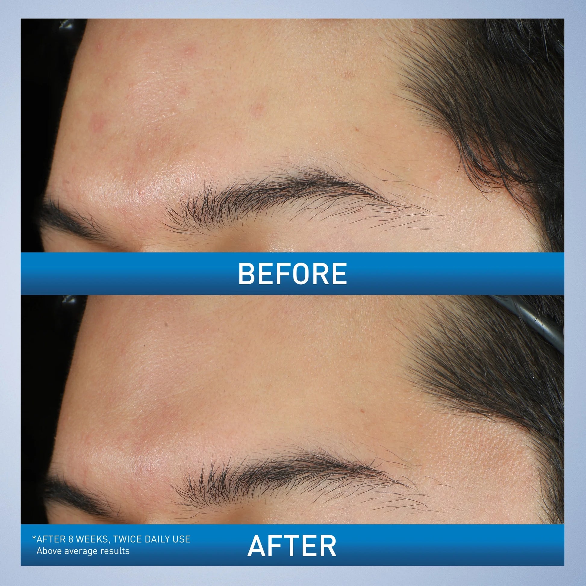 Cera Ve Acne Foaming Cream Wash with 10% Benzoyl Peroxide for Face & Body, 5 Oz