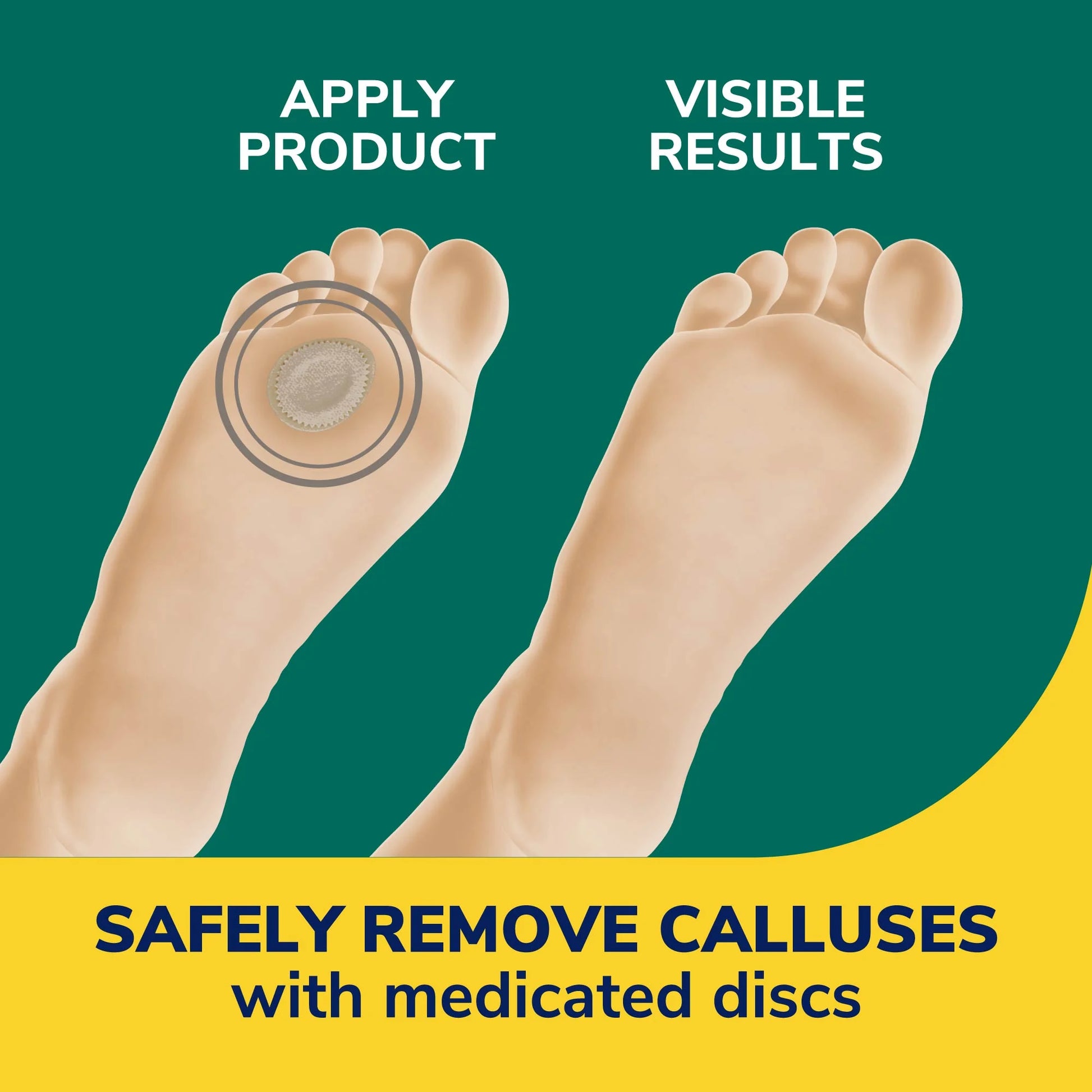 Callus Remover Cushions & Softens – 4 Count Pack