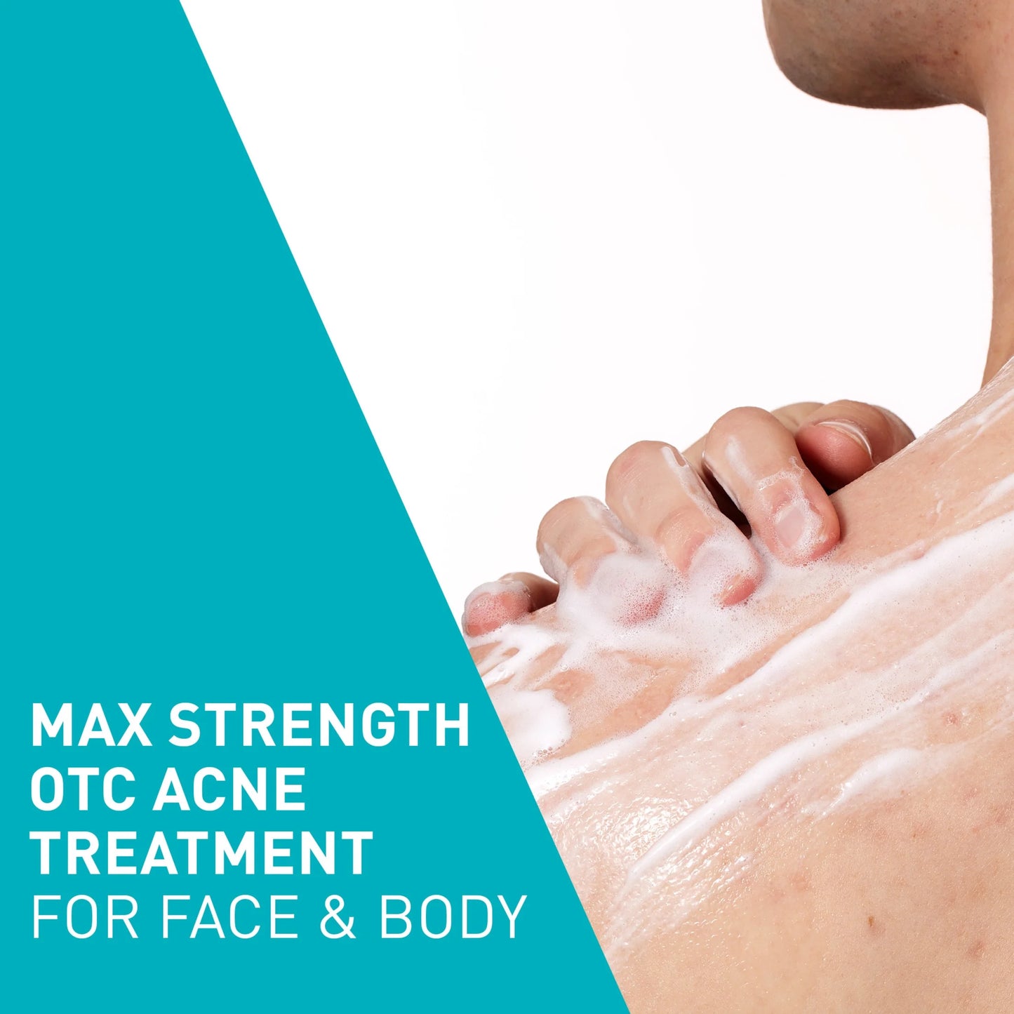 Cera Ve Acne Foaming Cream Wash with 10% Benzoyl Peroxide for Face & Body, 5 Oz