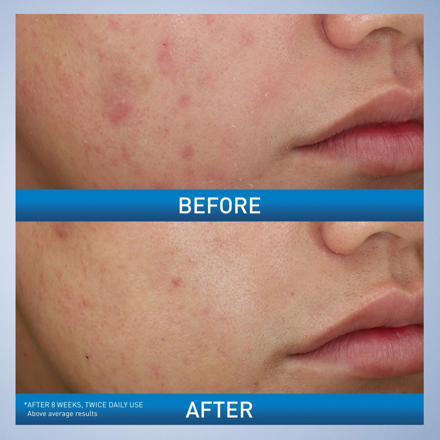 Cera Ve Acne Foaming Cream Wash with 10% Benzoyl Peroxide for Face & Body, 5 Oz