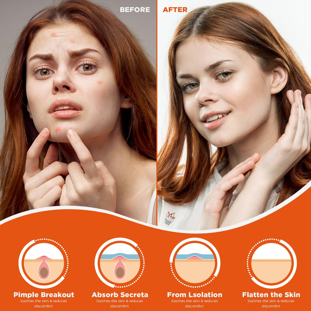 Acne Pimple Patches (60 Count) – Hydrocolloid Spot Dots for Fast Healing & Blemish Cover